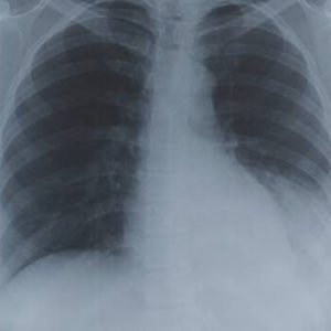 expat-asked-to-leave-uae-due-to-old-tb-scars