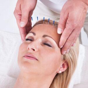 Acupuncture1 300x300
